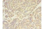 Immunohistochemistry of paraffin-embedded human breast cancer using CSB-PA009101LA01HU at dilution of 1:100