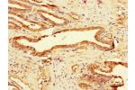 Immunohistochemistry of paraffin-embedded human prostate cancer using CSB-PA009125LA01HU at dilution of 1:100