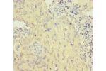 Immunohistochemistry of paraffin-embedded human lung cancer using CSB-PA009164HA01HU at dilution 1:100