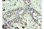 Immunohistochemistry of paraffin-embedded human breast cancer using CSB-PA009228ESR2HU at dilution 1:100