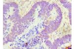 Immunohistochemistry of paraffin-embedded human ovarian cancer using CSB-PA009349ESR1HU at dilution 1:100