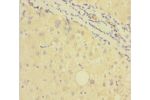 Immunohistochemistry of paraffin-embedded human liver cancer using CSB-PA009352EA01HU at dilution 1:100