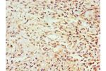 Immunohistochemistry of paraffin-embedded human breast cancer using CSB-PA009362ESR2HU at dilution 1:100