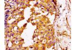 IHC image of CSB-PA009388LA01HU diluted at 1:100 and staining in paraffin-embedded human breast cancer performed on a Leica BondTM system. After dewaxing and hydration, antigen retrieval was mediated by high pressure in a citrate buffer (pH 6.0). Section 