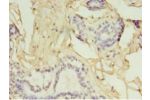 Immunohistochemistry of paraffin-embedded human breast cancer using CSB-PA009393HA01HU at dilution 1:100