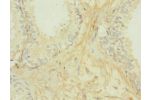 Immunohistochemistry of paraffin-embedded human prostata cancer using CSB-PA009438ESR2HU at dilution 1:100