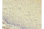 Immunohistochemistry of paraffin-embedded human cervical cancer using CSB-PA009453LA01HU at dilution of 1:100