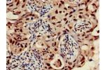 Immunohistochemistry of paraffin-embedded human lung cancer using CSB-PA009458EA01HU at dilution of 1:100