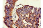 Immunohistochemistry of paraffin-embedded human colon cancer using CSB-PA009476LA01HU at dilution of 1:100
