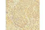 Immunohistochemistry of paraffin-embedded human ovarian cancer using CSB-PA009521EA01HU at dilution 1:100