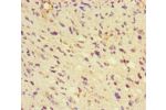 Immunohistochemistry of paraffin-embedded human glioma cancer using CSB-PA009553LA01HU at dilution of 1:100