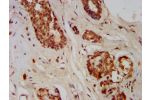 IHC image of CSB-PA009569LA01HU diluted at 1:400 and staining in paraffin-embedded human breast cancer performed on a Leica BondTM system. After dewaxing and hydration, antigen retrieval was mediated by high pressure in a citrate buffer (pH 6.0). Section 