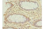 Immunohistochemistry of paraffin-embedded human colon cancer using CSB-PA009610LA01HU at dilution of 1:100