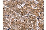 The image on the left is immunohistochemistry of paraffin-embedded Human liver cancer tissue using CSB-PA010637(EPDR1 Antibody) at dilution 1/40, on the right is treated with fusion protein. (Original magnification: 