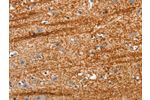 The image on the left is immunohistochemistry of paraffin-embedded Human brain tissue using CSB-PA010692(APC Antibody) at dilution 1/25, on the right is treated with synthetic peptide. (Original magnification: 