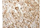 The image on the left is immunohistochemistry of paraffin-embedded Human esophagus cancer tissue using CSB-PA011355(ADIPOR2 Antibody) at dilution 1/15, on the right is treated with synthetic peptide. (Original magnification: 