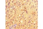 Immunohistochemistry of paraffin-embedded human glioma cancer using CSB-PA011825LA01HU at dilution of 1:100