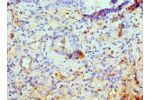 Immunohistochemistry of paraffin-embedded human lung cancer using CSB-PA012203ESR1HU at dilution 1:100