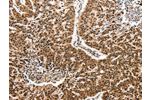 The image on the left is immunohistochemistry of paraffin-embedded Human lung cancer tissue using CSB-PA012674(CCL2 Antibody) at dilution 1/50, on the right is treated with synthetic peptide. (Original magnification: 