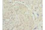 Immunohistochemistry of paraffin-embedded human lung cancer using CSB-PA012854ESR1HU at dilution 1:100