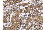The image on the left is immunohistochemistry of paraffin-embedded Human gastic cancer tissue using CSB-PA013118(BAI1 Antibody) at dilution 1/40, on the right is treated with synthetic peptide. (Original magnification: 