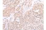 The image on the left is immunohistochemistry of paraffin-embedded Human lung cancer tissue using CSB-PA014237(F7 Antibody) at dilution 1/40, on the right is treated with fusion protein. (Original magnification: 