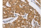 The image on the left is immunohistochemistry of paraffin-embedded Human breast cancer tissue using CSB-PA014480(AGAP2 Antibody) at dilution 1/30, on the right is treated with synthetic peptide. (Original magnification: 