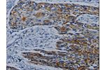 The image on the left is immunohistochemistry of paraffin-embedded Human esophagus cancer tissue using CSB-PA015008(CPT2 Antibody) at dilution 1/10, on the right is treated with synthetic peptide. (Original magnification: 