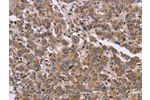 The image on the left is immunohistochemistry of paraffin-embedded Human liver cancer tissue using CSB-PA015538(FAM3B Antibody) at dilution 1/30, on the right is treated with fusion protein. (Original magnification: 