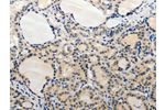 The image on the left is immunohistochemistry of paraffin-embedded Human thyroid cancer tissue using CSB-PA015833(ADAMTS6 Antibody) at dilution 1/20, on the right is treated with synthetic peptide. (Original magnification: 