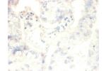 Immunohistochemistry of paraffin-embeded human ovarian cancer using CSB-PA01655A0Rb at dilution of 1:50
