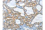 The image on the left is immunohistochemistry of paraffin-embedded Human thyroid cancer tissue using CSB-PA016618(CNTNAP3 Antibody) at dilution 1/30, on the right is treated with synthetic peptide. (Original magnification: 