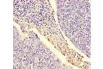 Immunohistochemistry of paraffin-embedded human cervical cancer using CSB-PA01679A0Rb at dilution of 1:100