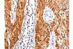 The image on the left is immunohistochemistry of paraffin-embedded Human esophagus cancer tissue using CSB-PA016832(FBLN1 Antibody) at dilution 1/47, on the right is treated with synthetic peptide. (Original magnification: 