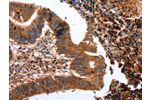 The image on the left is immunohistochemistry of paraffin-embedded Human colon cancer tissue using CSB-PA016840(CLEC4A Antibody) at dilution 1/15, on the right is treated with fusion protein. (Original magnification: 