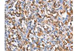 The image on the left is immunohistochemistry of paraffin-embedded Human thyroid cancer tissue using CSB-PA016936(CD226 Antibody) at dilution 1/60, on the right is treated with synthetic peptide. (Original magnification: 
