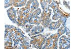 The image on the left is immunohistochemistry of paraffin-embedded Human thyroid cancer tissue using CSB-PA017010(CLPTM1L Antibody) at dilution 1/60, on the right is treated with synthetic peptide. (Original magnification: 