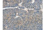 The image on the left is immunohistochemistry of paraffin-embedded Human liver cancer tissue using CSB-PA017108(ATP4B Antibody) at dilution 1/40, on the right is treated with fusion protein. (Original magnification: 