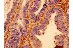 Immunohistochemistry of paraffin-embedded human colon cancer using CSB-PA01714A0Rb at dilution of 1:100