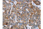 The image on the left is immunohistochemistry of paraffin-embedded Human liver cancer tissue using CSB-PA017354(CHDH Antibody) at dilution 1/20, on the right is treated with fusion protein. (Original magnification: 
