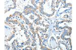 The image on the left is immunohistochemistry of paraffin-embedded Human thyroid cancer tissue using CSB-PA017442(ADRA1A Antibody) at dilution 1/40, on the right is treated with synthetic peptide. (Original magnification: 