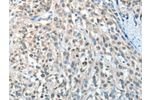 The image on the left is immunohistochemistry of paraffin-embedded Human esophagus cancer tissue using CSB-PA017539(AGBL3 Antibody) at dilution 1/25, on the right is treated with fusion protein. (Original magnification: 