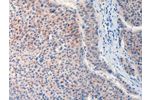 The image on the left is immunohistochemistry of paraffin-embedded Human liver cancer tissue using CSB-PA017577(FAT4 Antibody) at dilution 1/20, on the right is treated with synthetic peptide. (Original magnification: 