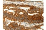 The image on the left is immunohistochemistry of paraffin-embedded Human colon cancer tissue using CSB-PA017662(COX7B Antibody) at dilution 1/70, on the right is treated with fusion protein. (Original magnification: 