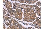 The image on the left is immunohistochemistry of paraffin-embedded Human breast cancer tissue using CSB-PA018113(EGR4 Antibody) at dilution 1/20, on the right is treated with synthetic peptide. (Original magnification: 