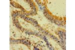 Immunohistochemistry of paraffin-embedded human endometrial cancer using CSB-PA01825A0Rb at dilution of 1:100