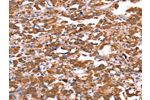 The image on the left is immunohistochemistry of paraffin-embedded Human thyroid cancer tissue using CSB-PA018431(FXR1 Antibody) at dilution 1/20, on the right is treated with synthetic peptide. (Original magnification: 