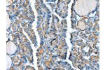 The image on the left is immunohistochemistry of paraffin-embedded Human thyroid cancer tissue using CSB-PA020499(ADCY4 Antibody) at dilution 1/30, on the right is treated with fusion protein. (Original magnification: 