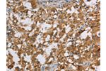 The image on the left is immunohistochemistry of paraffin-embedded Human thyroid cancer tissue using CSB-PA020742(DBH Antibody) at dilution 1/70, on the right is treated with fusion protein. (Original magnification: 