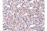 The image on the left is immunohistochemistry of paraffin-embedded Human thyroid cancer tissue using CSB-PA021005(FGF16 Antibody) at dilution 1/30, on the right is treated with synthetic peptide. (Original magnification: 